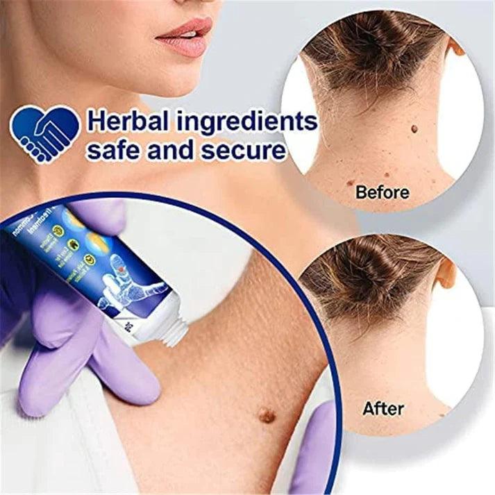 Wart Remover Instant Blemish Removal Cream - Image 3